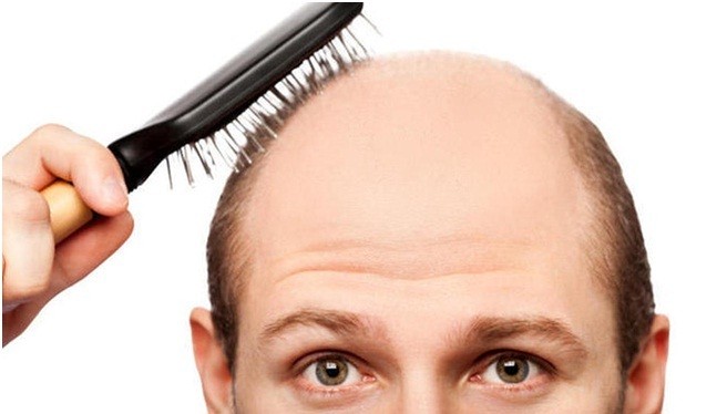Facts About Hair Transplant