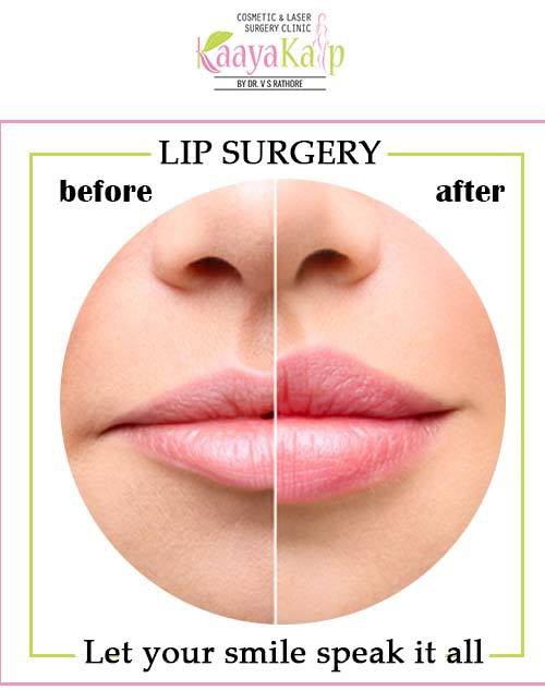 Lip Augmentation For Achieving Fuller Lips