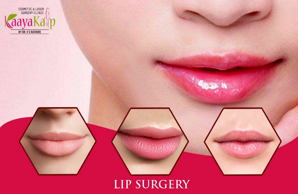 Lip Implants Procedure