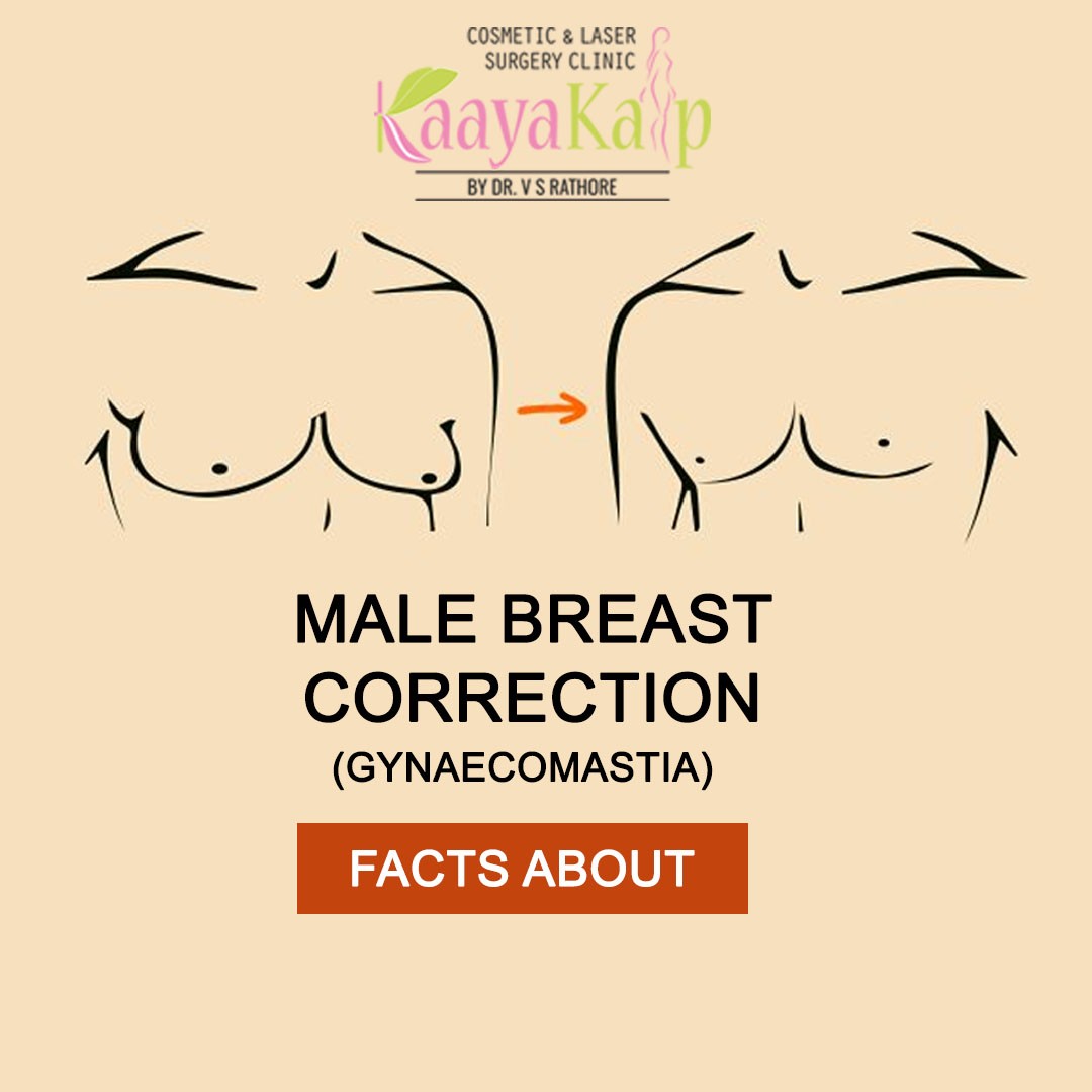 Facts One Should Know About Male Breast Reduction Surgery