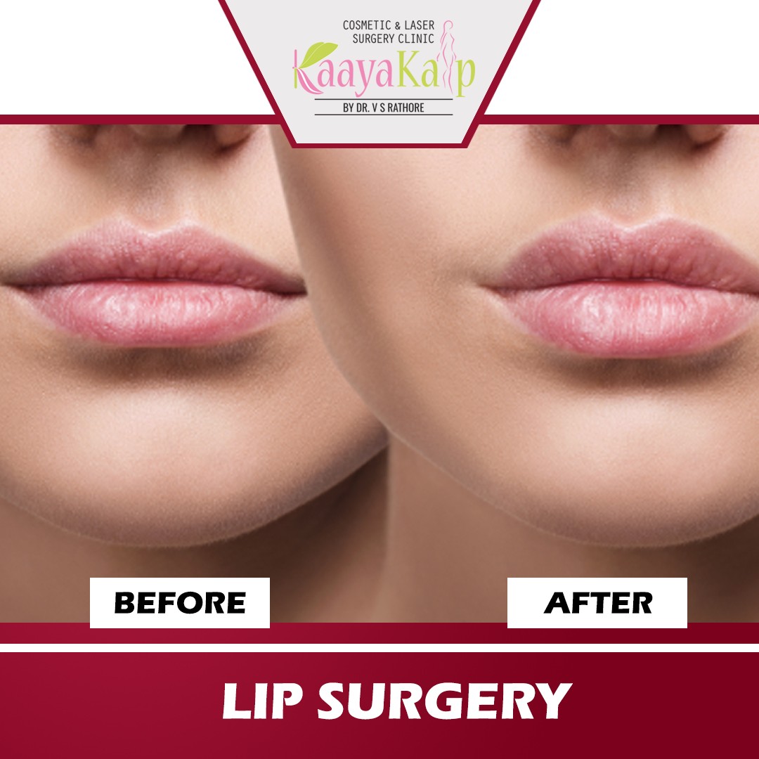 Benefits Of Lip Augmentation Surgery