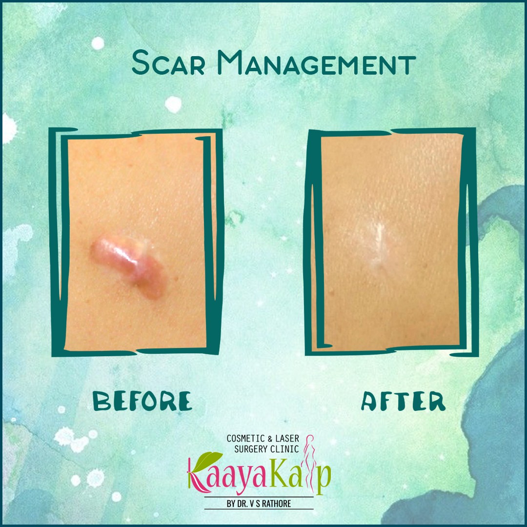 Scar treatment made easy and convenient like never before