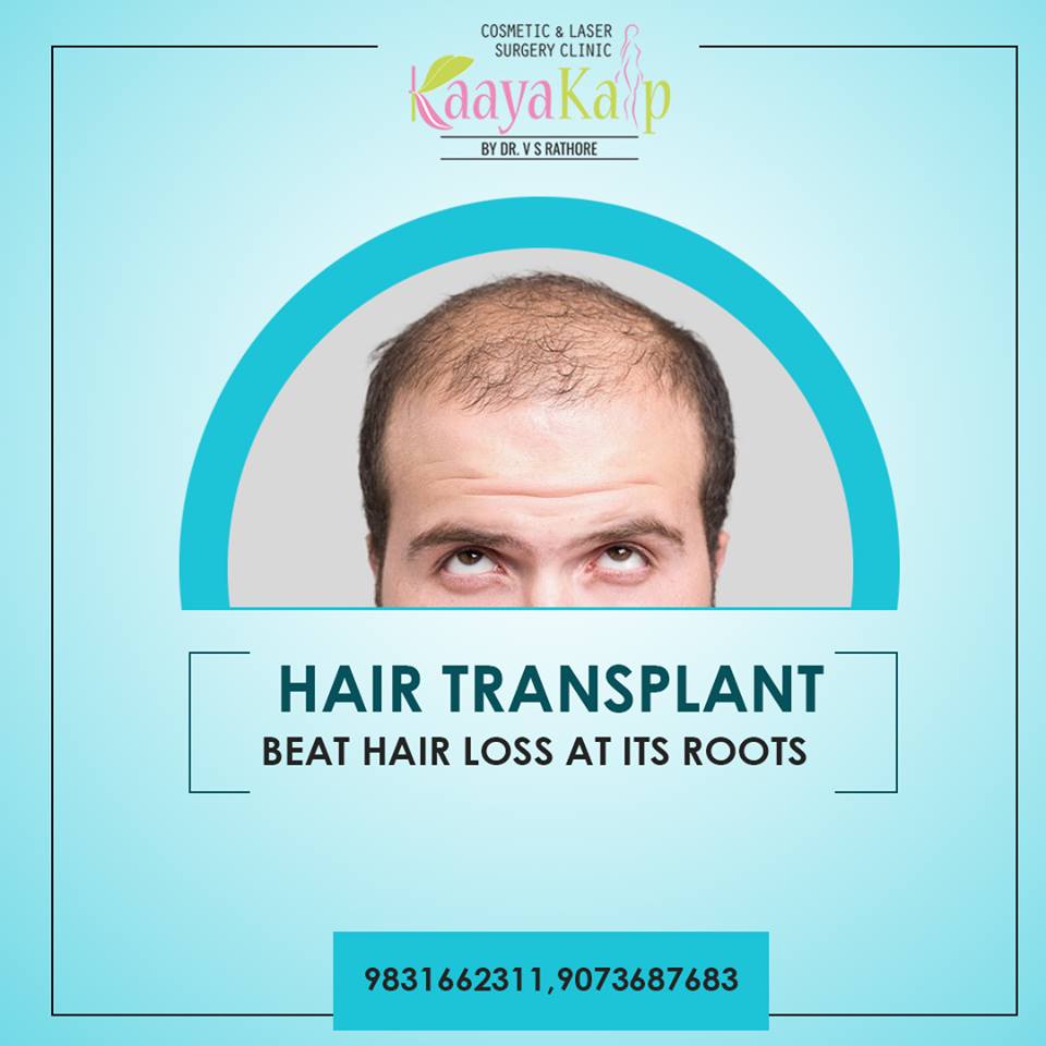 Does hair transplant surgery prevent hair loss? | Kaayakalp