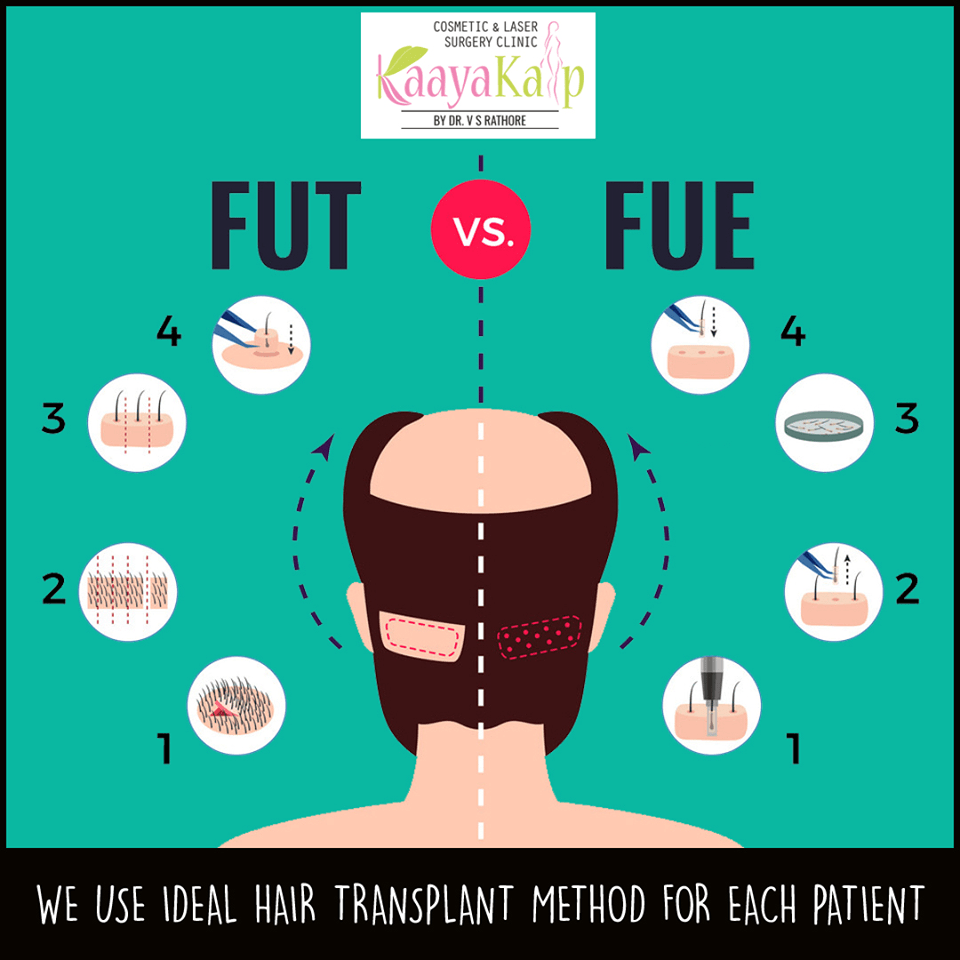 The FUT & FUE Methods of Hair Transplantation