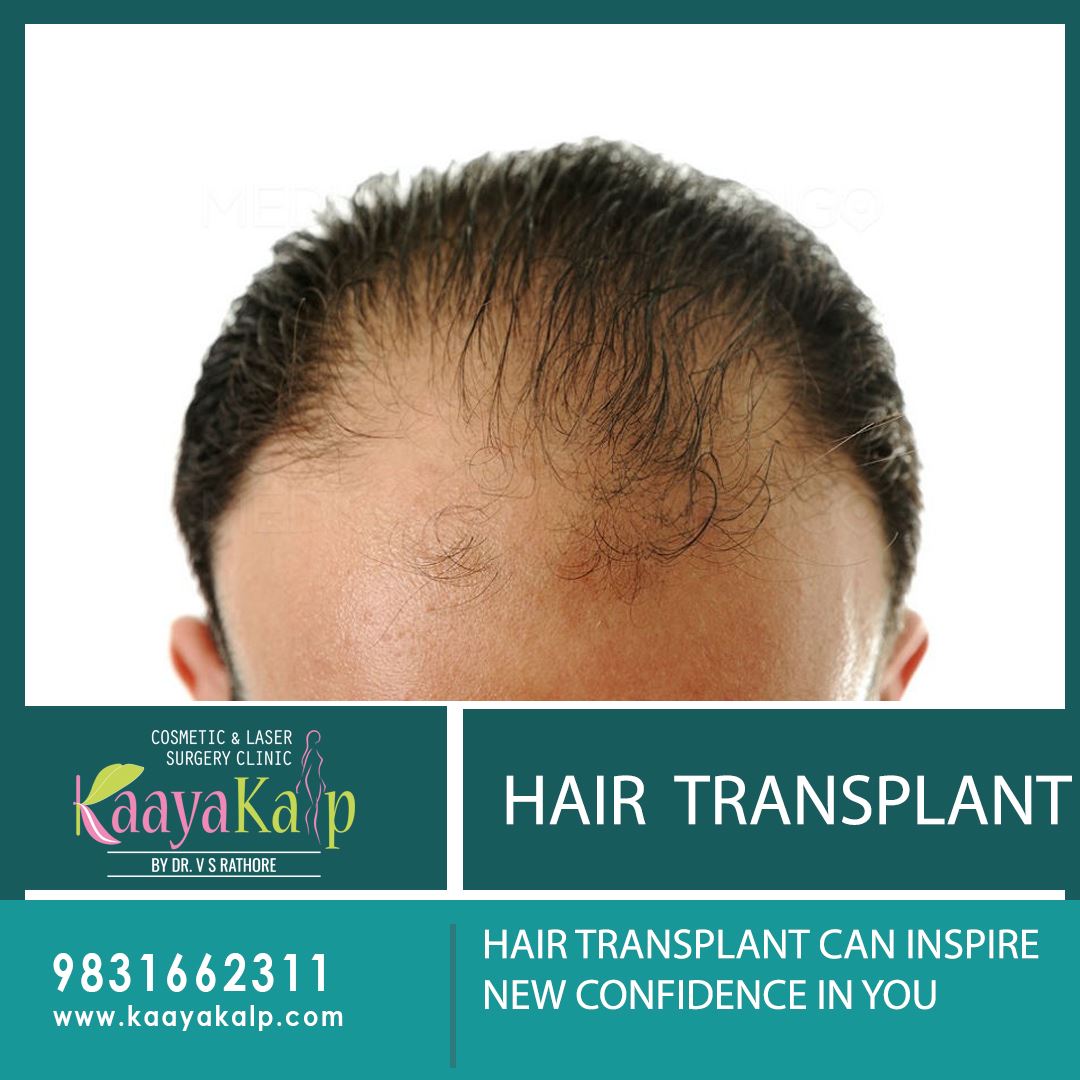 How does Hair Transplant treatment work in 2019? | Kaayakalp