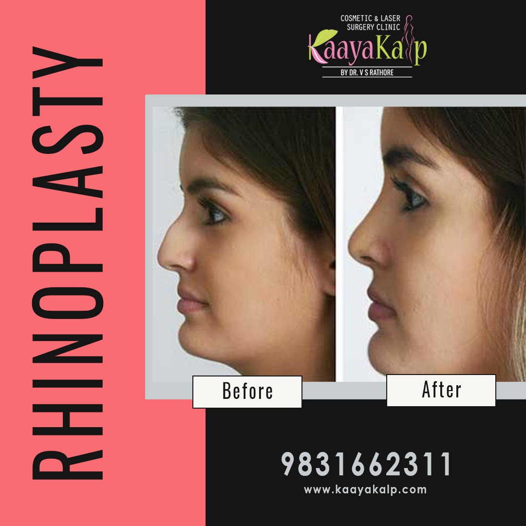 What are the Benefits of Rhinoplasty?