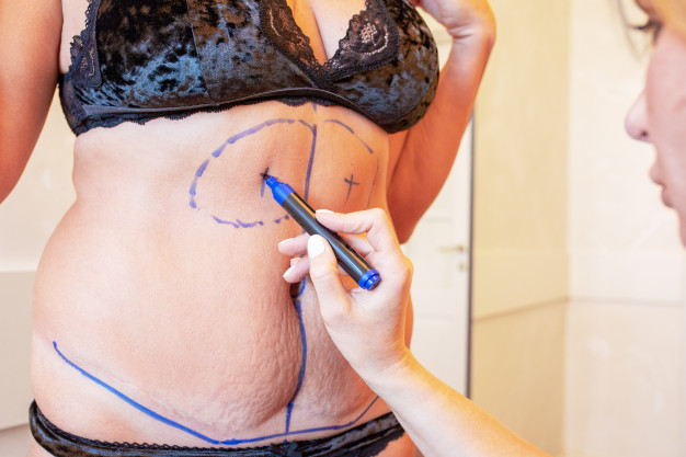 FACTS ABOUT ABDOMINOPLASTY