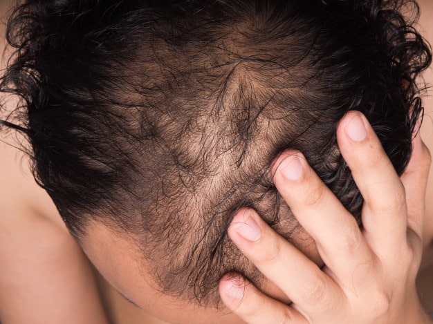 Is There Any Age Limit for Hair Transplant? | Kaayakalp
