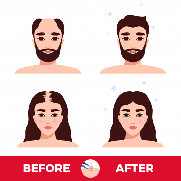 Hair Transplant aftercare Tips