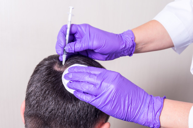 Can a Teenager get a Hair Transplant?