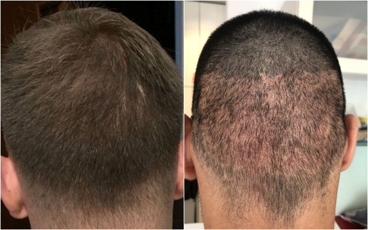 Advantages Of FUE Method Of Hair Transplant