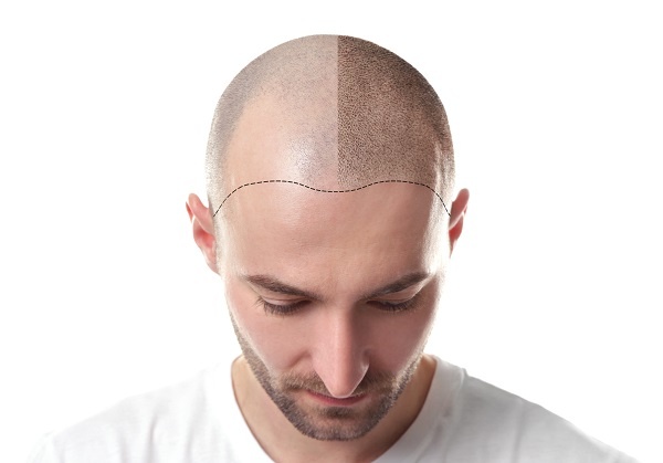 Can Hair Transplant Cause Any Side Effects? | Kaayakalp