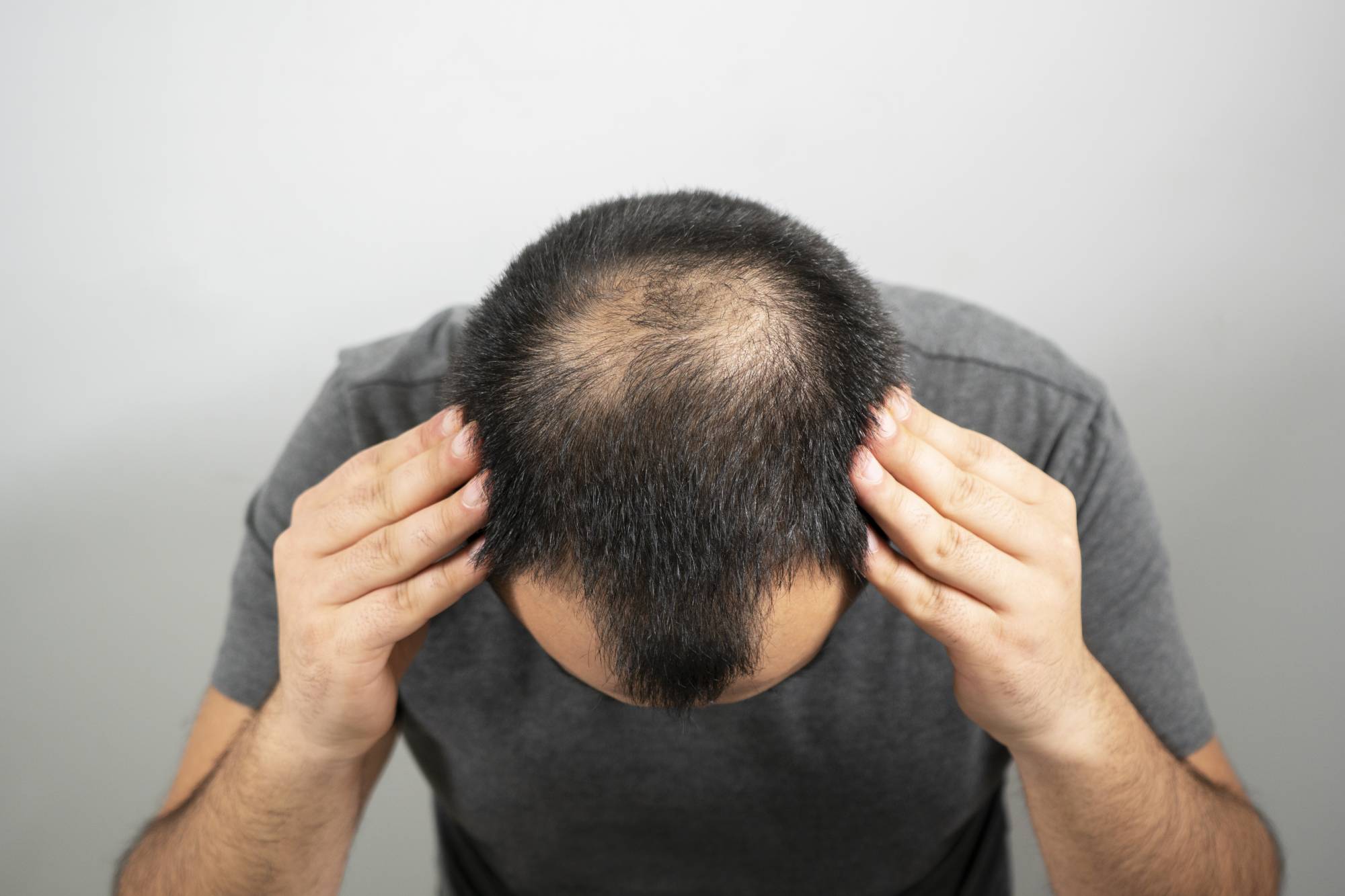 Shedding After Hair Transplant; Is It Normal?