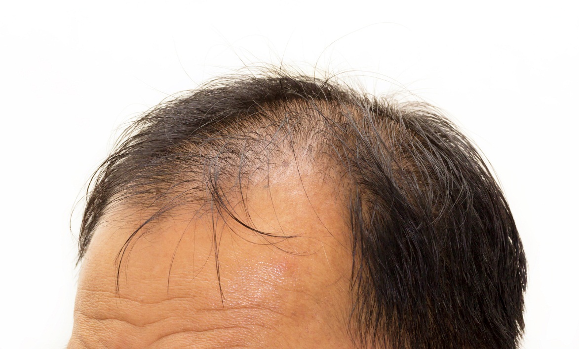 What Makes An Ideal Candidate For Hair Transplant Surgery