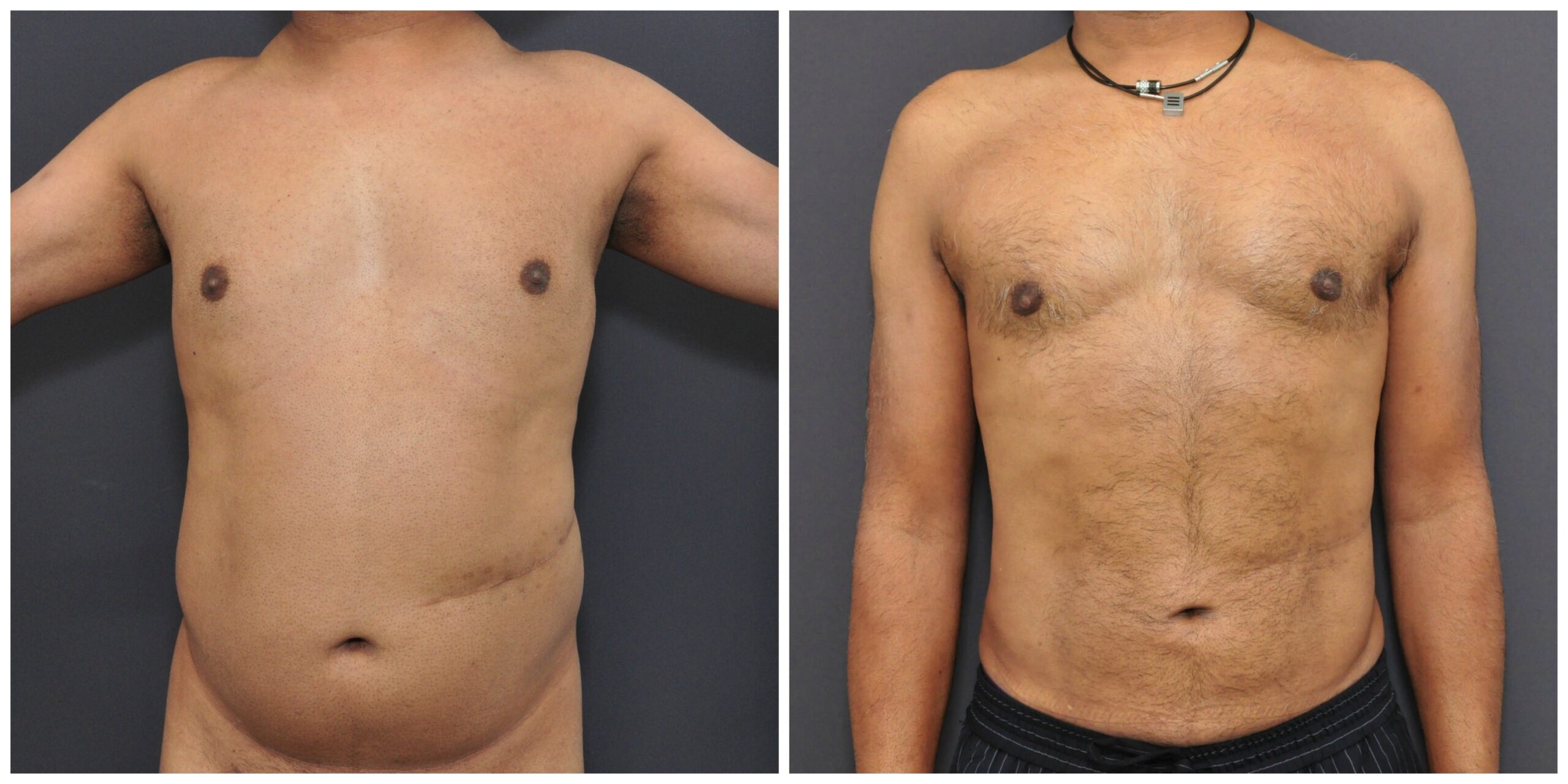 Best Liposuction Austin Tx