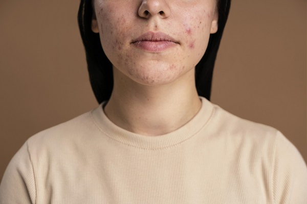 What Your Acne Is Trying To Tell You