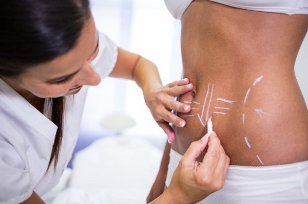 Why is Liposuction So Popular?