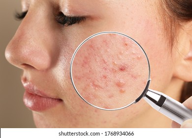 How to fight acne naturally?