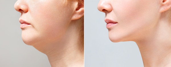 Interesting Facts You Should Know About Chin Surgery