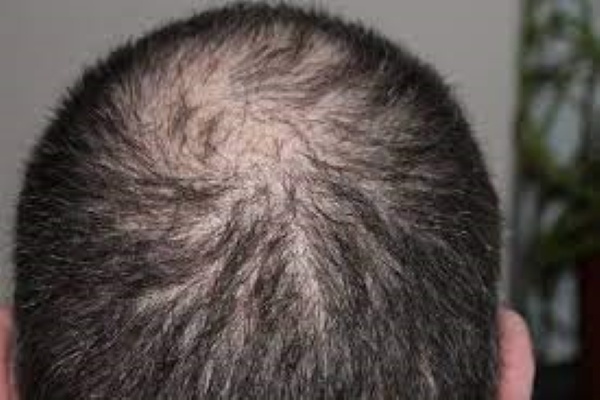 FUT Or FUE: Which Is The Best Method Of Hair Transplant In Kolkata?
