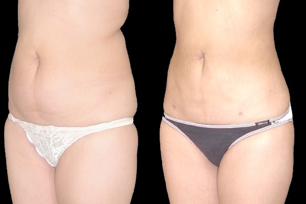 Factors to consider when getting an Abdominoplasty