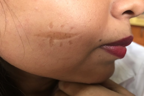 Things to know before having a laser scar treatment