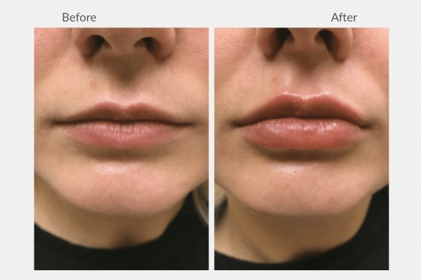 Lip Augmentation: Pre and Post-treatment precautions