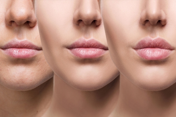 How can lip fillers make you look younger?