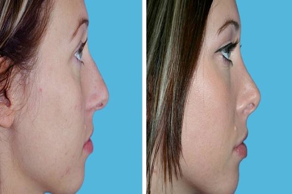 Five common myths about rhinoplasty