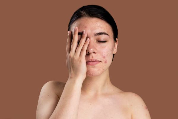 Skin Care Treatment For Fungal Acne In Kolkata: Everything You Need To Know