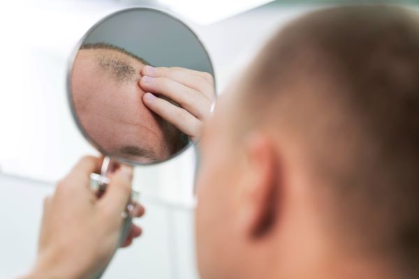 When Can You Expect To See Results After A Hair Transplant