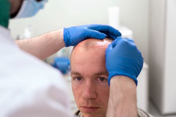 Hair Transplant in Kolkata