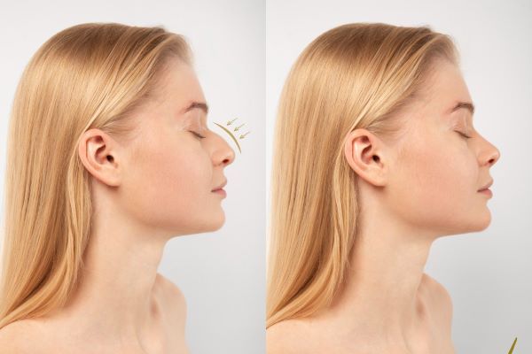 Rhinoplasty Cost In Kolkata: A Complete Guide To The Procedure
