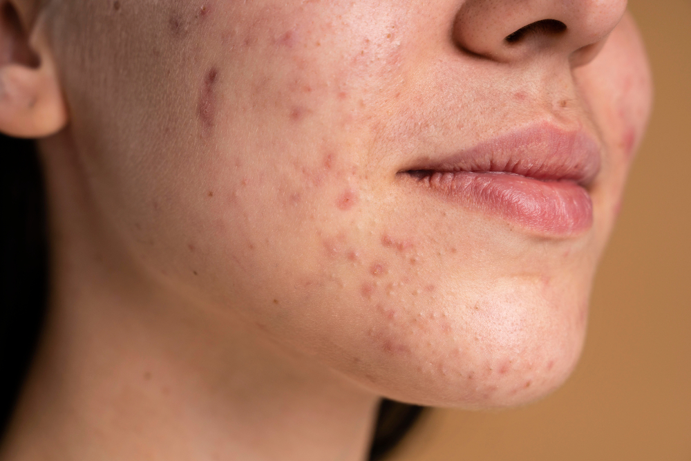 acne scare removal
